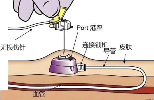 解锁输液港：精准维护及贴心居家护理秘籍